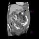 Anaplastic lymphoma in peritoneal cavity, retroperitoneal and mesenterial lymphadenopathy: CT - Computed tomography