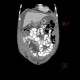 Anaplastic lymphoma in peritoneal cavity, retroperitoneal and mesenterial lymphadenopathy: CT - Computed tomography