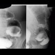 Anastomosis of large bowel on barium enema: RF - Fluoroscopy