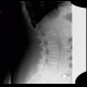 Aneurysm of abdominal aorta on plain radiograph, stent: X-ray - Plain radiograph