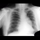 Aneurysm of thoracic aorta on chest radiograph: X-ray - Plain radiograph