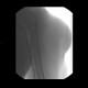 Angiography of lipoma, arm, thoracoacromial artery, preoperative, DSA: AG - Angiography