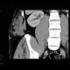 Angiolipoma, subcutaneous, selective embolisation: CT - Computed tomography