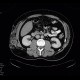 Angiolipoma, subcutaneous, selective embolisation: CT - Computed tomography