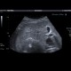 Angiomyolipoma of kidney: US - Ultrasound