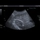 Angiomyolipoma of kidney: US - Ultrasound