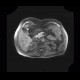 Angiomyolipoma of kidney, atypical: MRI - Magnetic Resonance Imaging