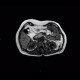 Angiomyolipoma of kidney, atypical: MRI - Magnetic Resonance Imaging
