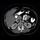 Angiomyolipoma of kidney, atypical: CT - Computed tomography