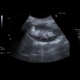 Angiomyolipoma: US - Ultrasound