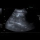 Angiomyolipoma of kidney, renal angiomyolipoma: US - Ultrasound