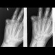 Ankylosis in Dupytren contracture: X-ray - Plain radiograph
