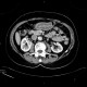 Gastritis, acute, antral: CT - Computed tomography