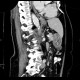 Gastritis, acute, antral: CT - Computed tomography