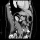 Gastritis, acute, antral: CT - Computed tomography