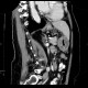 Gastritis, acute, antral: CT - Computed tomography