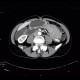 Aortomesenteric compression, SMA syndrome, superior mesenteric artery: CT - Computed tomography