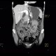 Aortomesenteric compression, SMA syndrome, superior mesenteric artery: CT - Computed tomography