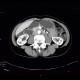 Aortomesenteric compression, SMA syndrome, superior mesenteric artery: CT - Computed tomography