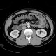 superior mesenteric artery syndrome, aortomesenteric compression: CT - Computed tomography