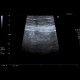 Acute appendicitis: US - Ultrasound