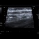 Acute appendicitis: US - Ultrasound