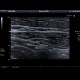 Appendicolith: US - Ultrasound