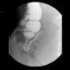 Appendicography, appendicolith, fecal stone: RF - Fluoroscopy
