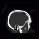 Arachnoid cyst, frontal lobe: CT - Computed tomography