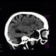 Arachnoidal cyst: CT - Computed tomography