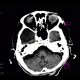 Arachnoidal cyst: CT - Computed tomography