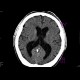 Arrested hydrocephalus: CT - Computed tomography