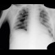 Myeloproliferative disorder, skeletal changes: X-ray - Plain radiograph