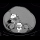 Myeloproliferative disorder, skeletal changes, splenomegally, artifact from failed detector: CT - Computed tomography