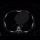 Myeloproliferative disorder, skeletal changes, splenomegally, artifact from failed detector: CT - Computed tomography