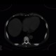 Myeloproliferative disorder, skeletal changes, splenomegally, artifact from failed detector: CT - Computed tomography