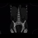 Myeloproliferative disorder, skeletal changes, splenomegally, artifact from failed detector: CT - Computed tomography