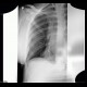 Hydropneumothorax, artifact: X-ray - Plain radiograph