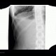 Hydropneumothorax, artifact: X-ray - Plain radiograph