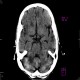 Artifact of posterior cranial fossa on CT (H32S): CT - Computed tomography