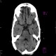 Artifact of posterior cranial fossa on CT (H31S): CT - Computed tomography