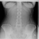 Artificial shadow, abdominal radiograph: X-ray - Plain radiograph