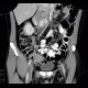 Artificial mass in the coecum: CT - Computed tomography