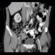 Artificial mass in the coecum: CT - Computed tomography