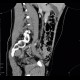 Artificial mass in the coecum: CT - Computed tomography