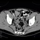 Artificial mass in the coecum: CT - Computed tomography
