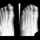 Aseptic necrosis of the head of second metatarsal bone, Freiberg-Kohler disease: X-ray - Plain radiograph