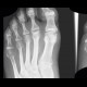 Aseptic necrosis of the head of second metatarsal bone, Freiberg-Kohler disease: X-ray - Plain radiograph