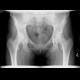 Aseptic necrosis of femoral head: X-ray - Plain radiograph