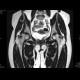 Aseptic necrosis of femoral head: MRI - Magnetic Resonance Imaging